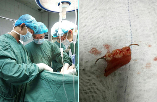 一片真心“大戰(zhàn)”一副假牙